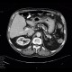Chronic calcified pancreatitis: CT - Computed tomography